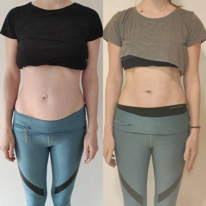 Tupler Technik Vorher-Nachher-Fotos