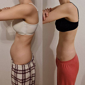 Tupler Technik Vorher-Nachher-Fotos